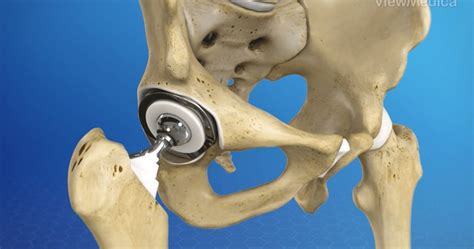 Hip Replacement Surgery .